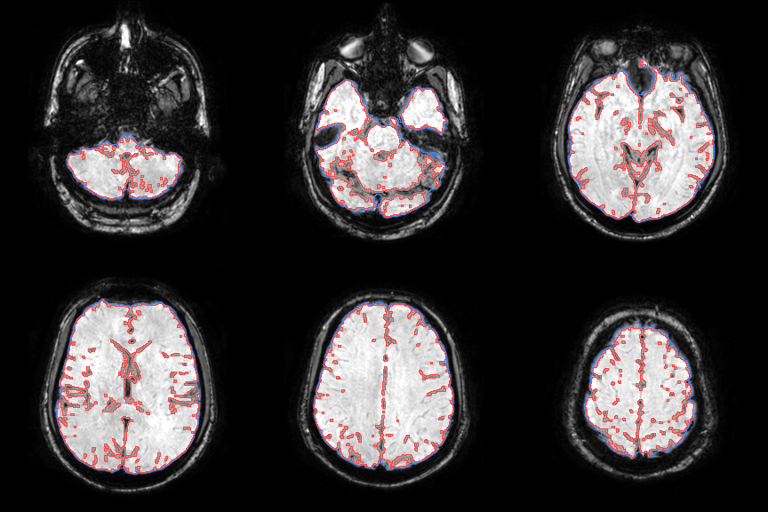 Brain mask drawn over the SWI slices